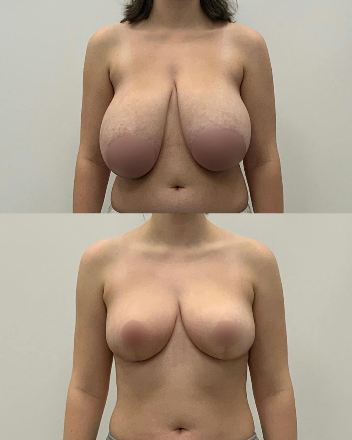 Breast Lift Before & After Gallery - Patient 284764 - Image 1