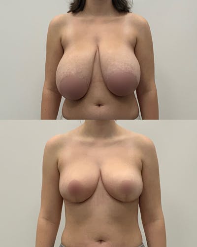 Breast Lift Before & After Gallery - Patient 284764 - Image 1