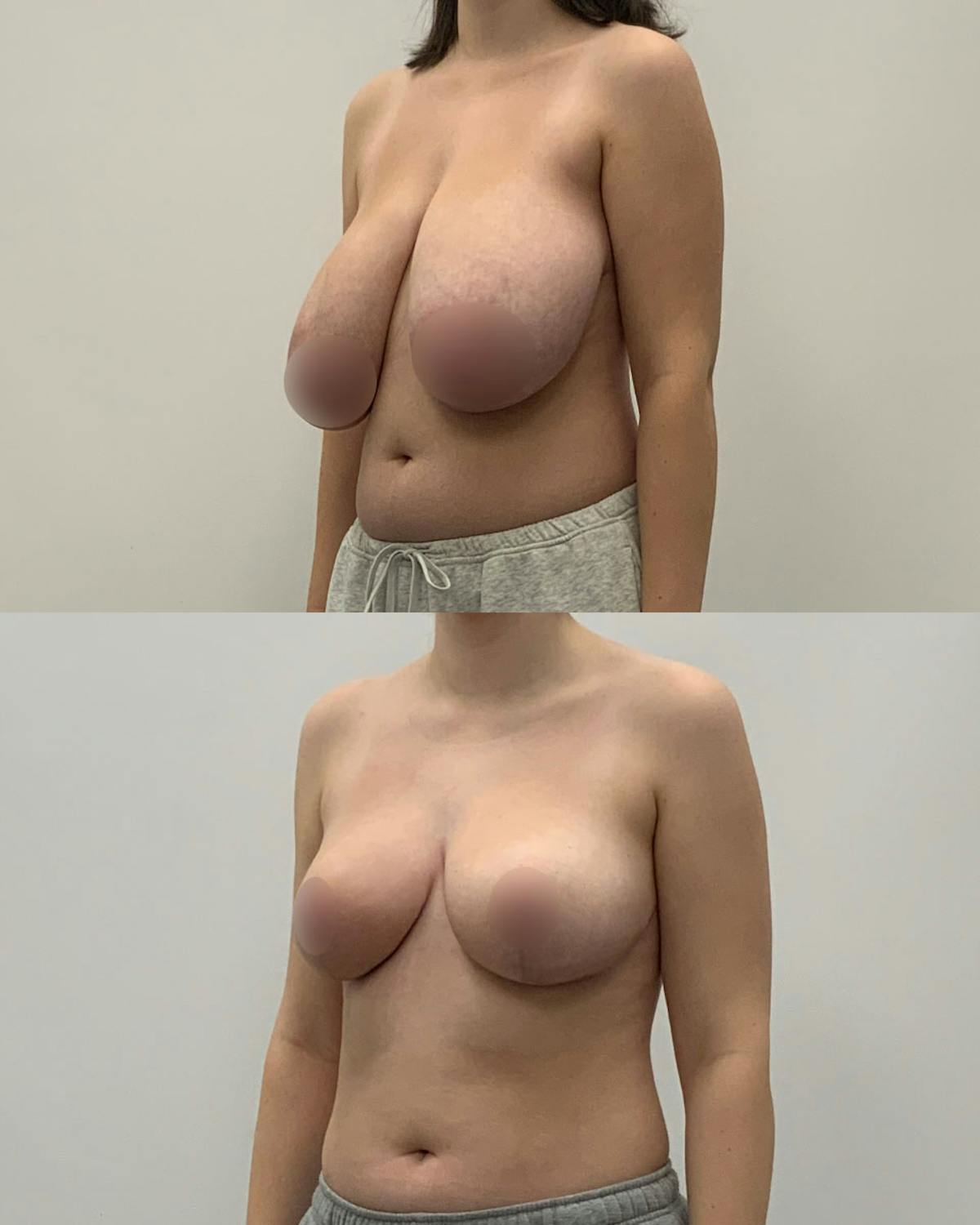 Breast Lift Before & After Gallery - Patient 284764 - Image 2