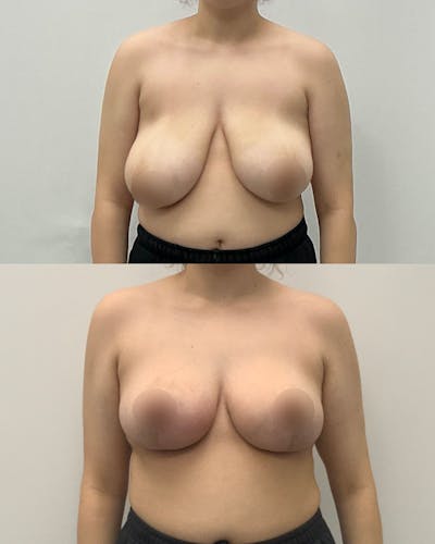Breast Lift Before & After Gallery - Patient 497834 - Image 1