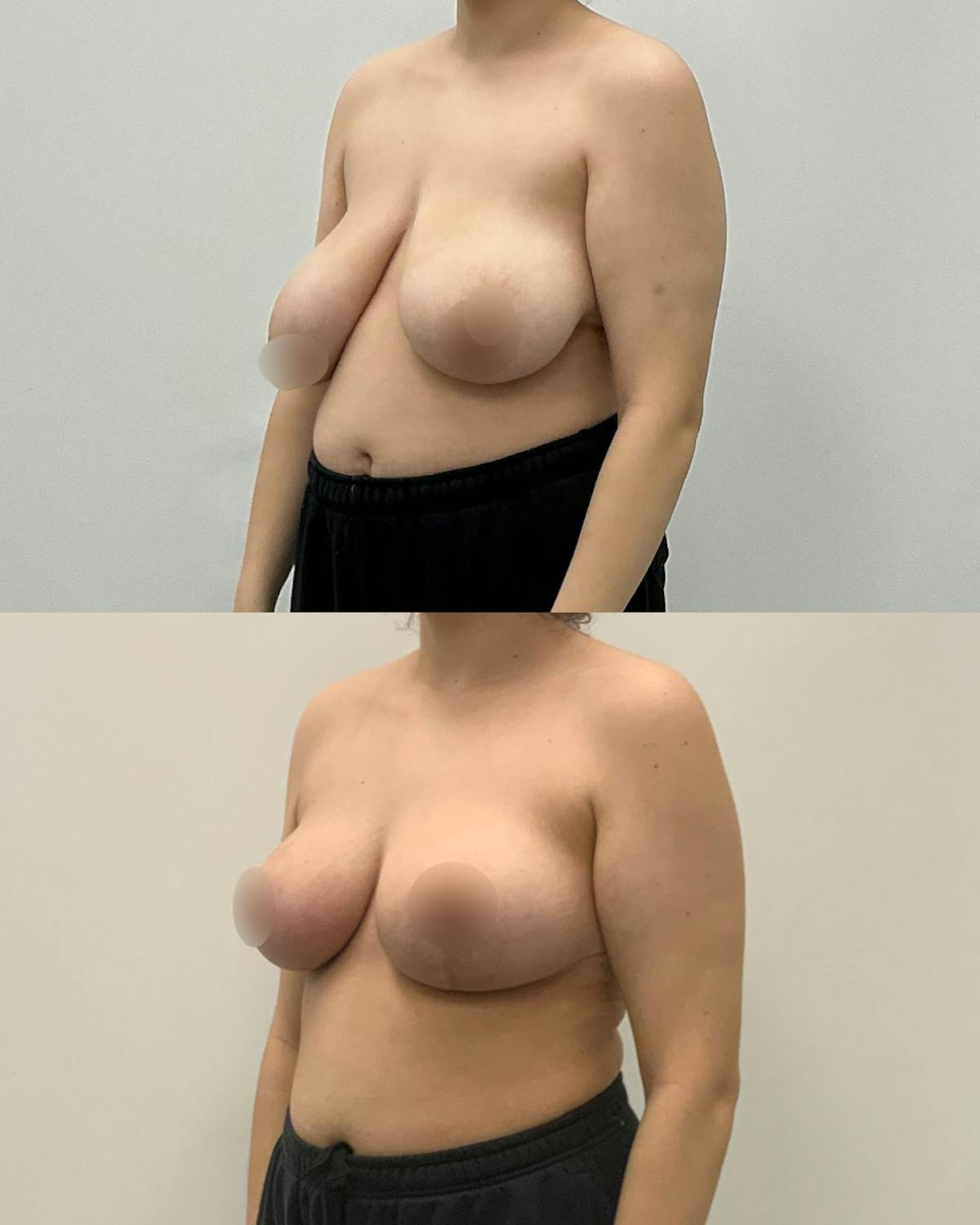 Breast Lift Before & After Gallery - Patient 497834 - Image 2
