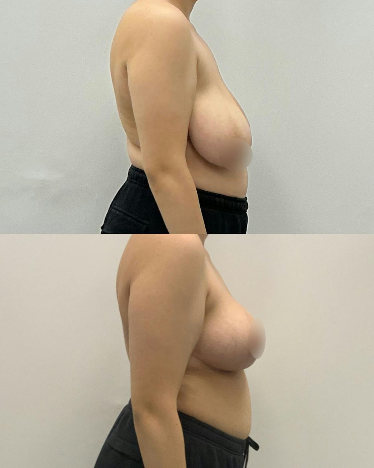Breast Lift Before & After Gallery - Patient 497834 - Image 3