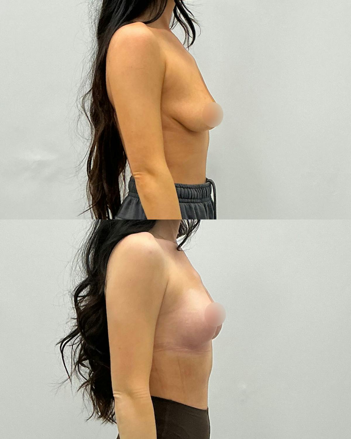 Breast Lift Before & After Gallery - Patient 230866 - Image 3