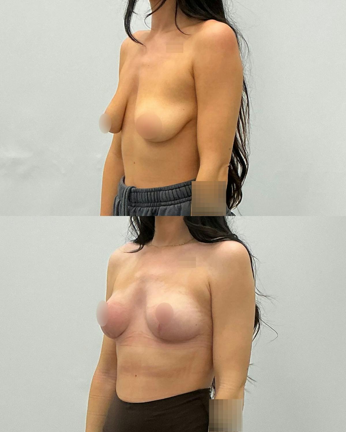 Breast Lift Before & After Gallery - Patient 230866 - Image 2