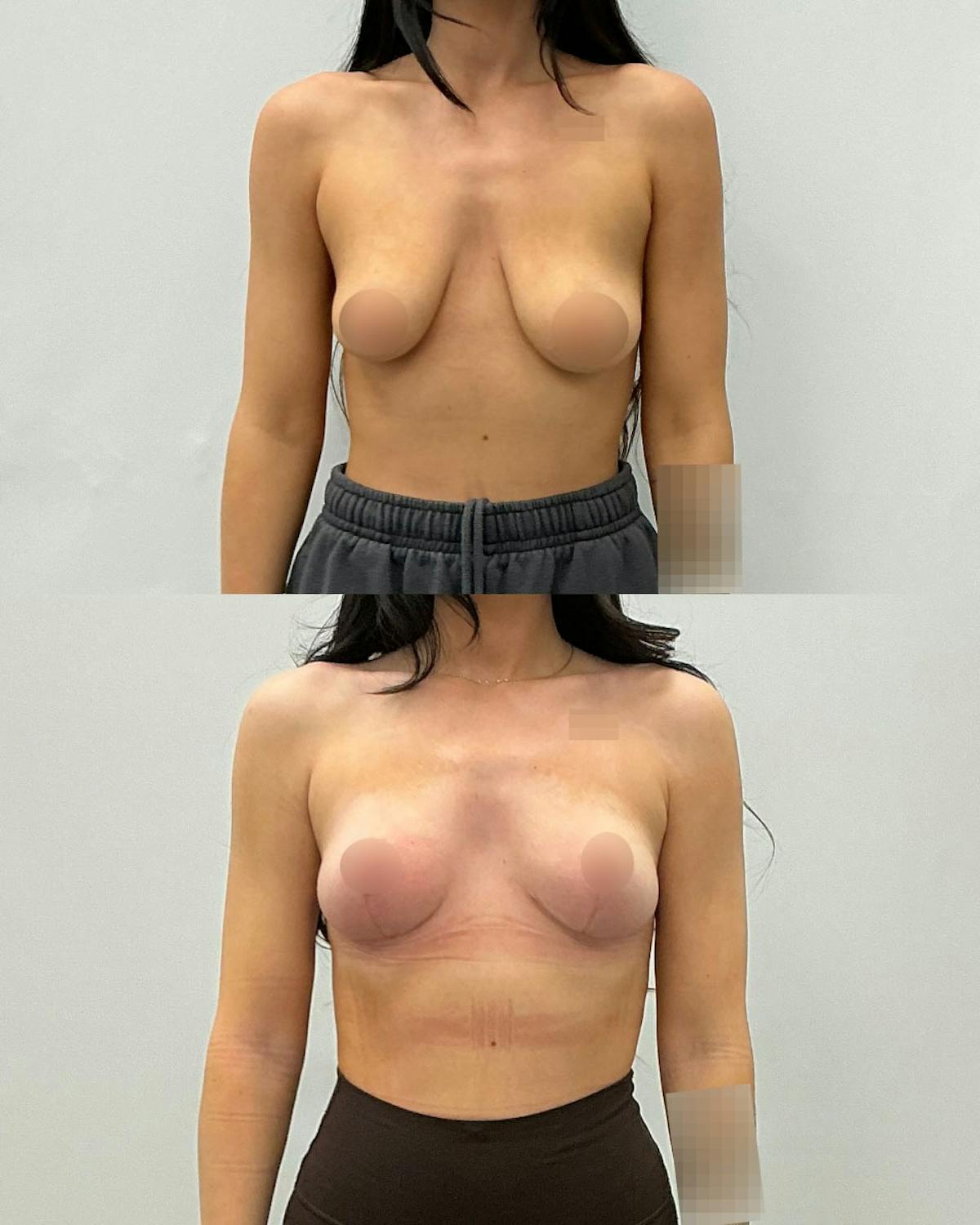 Breast Lift Before & After Gallery - Patient 230866 - Image 1
