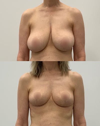 Breast Lift Before & After Gallery - Patient 162844 - Image 1