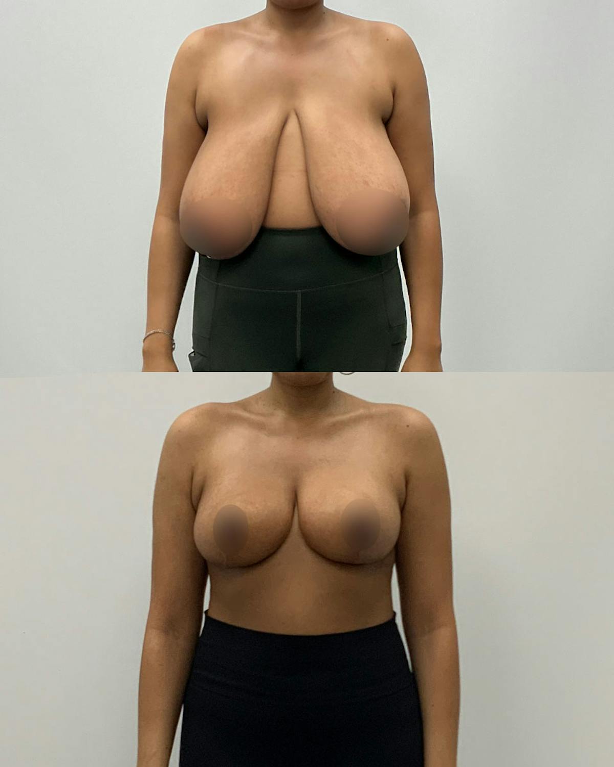 Breast Lift Before & After Gallery - Patient 105371 - Image 1