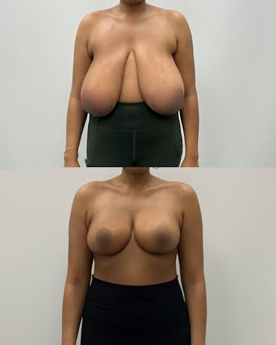 Breast Lift Before & After Gallery - Patient 105371 - Image 1