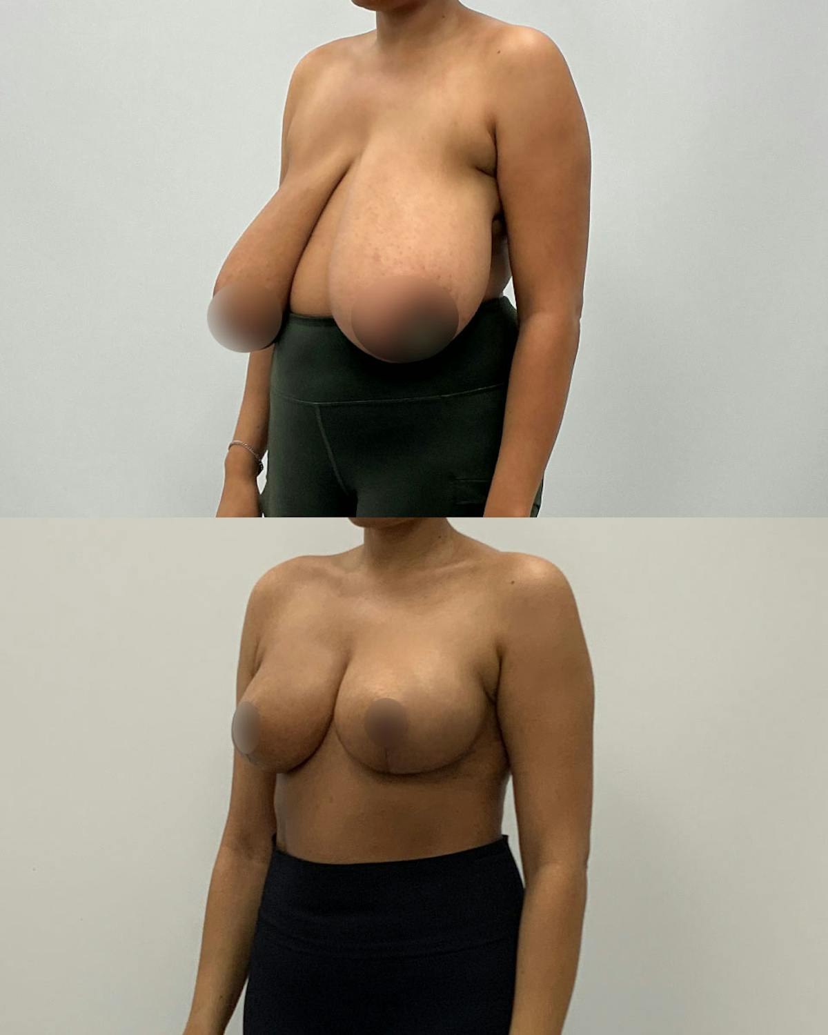 Breast Lift Before & After Gallery - Patient 105371 - Image 2