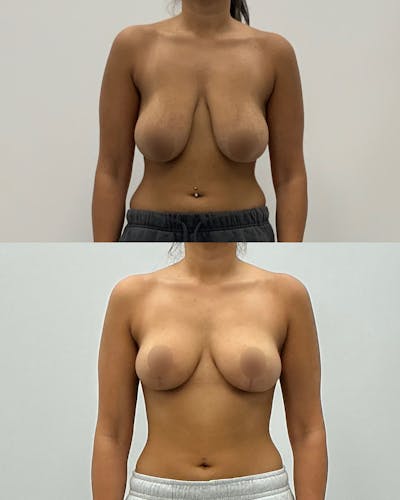 Breast Lift Before & After Gallery - Patient 174066 - Image 1