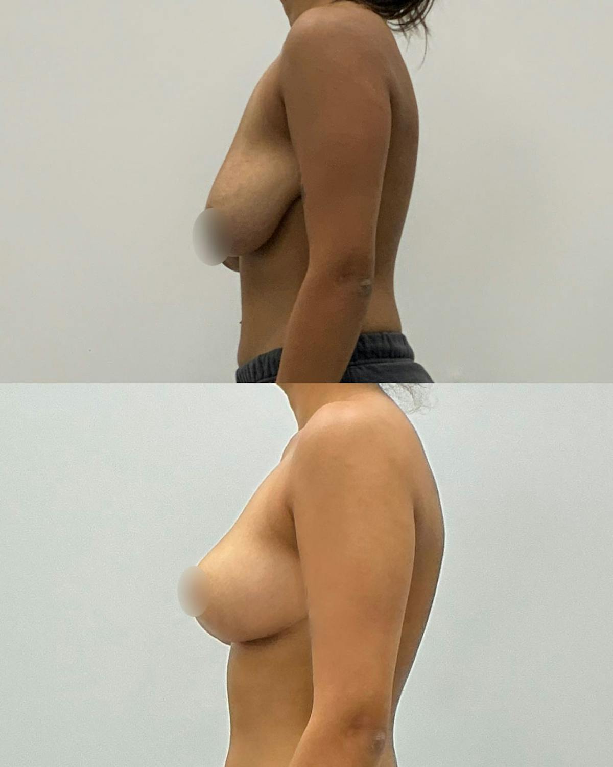 Breast Lift Before & After Gallery - Patient 174066 - Image 3