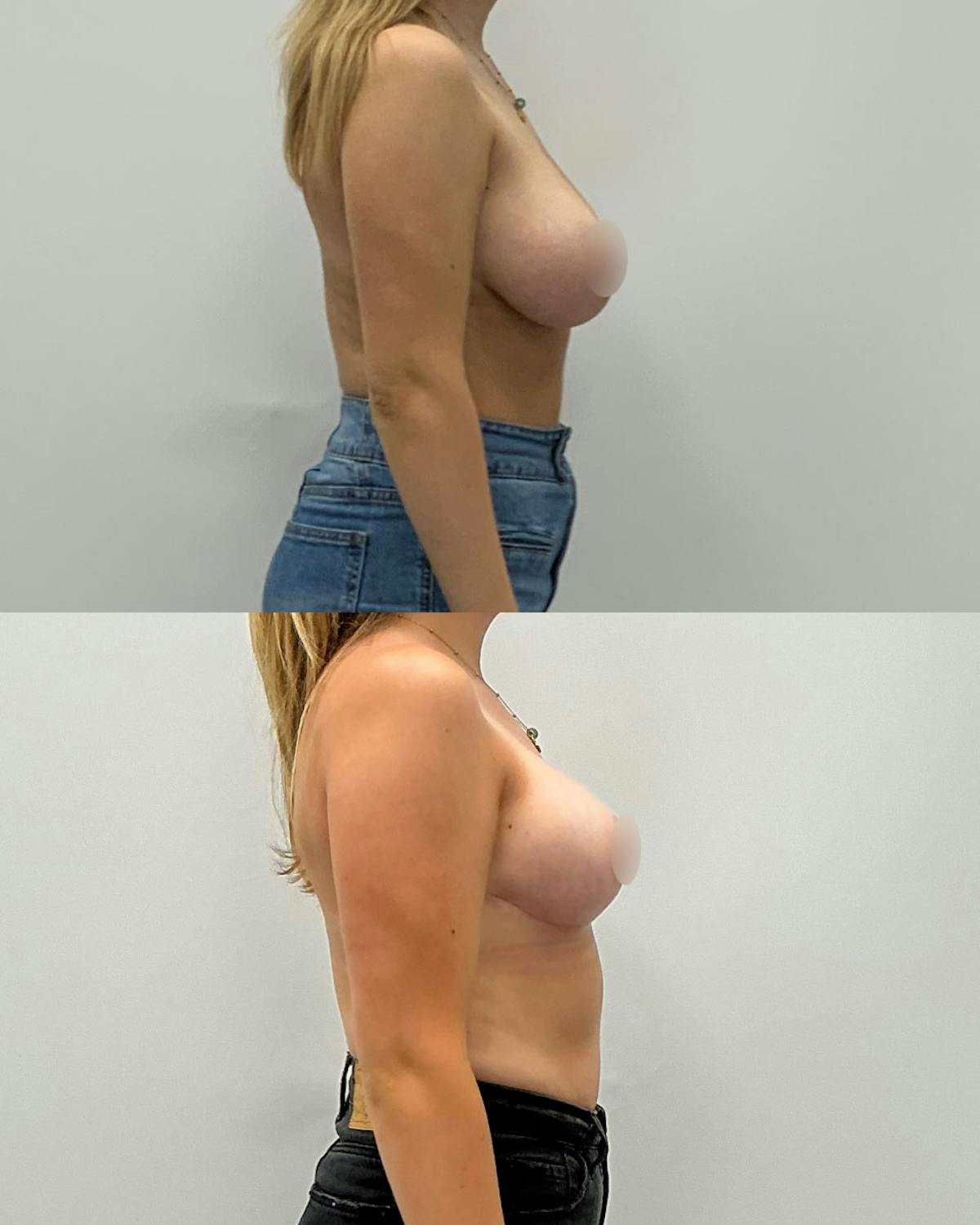 Breast Lift Before & After Gallery - Patient 282665 - Image 3