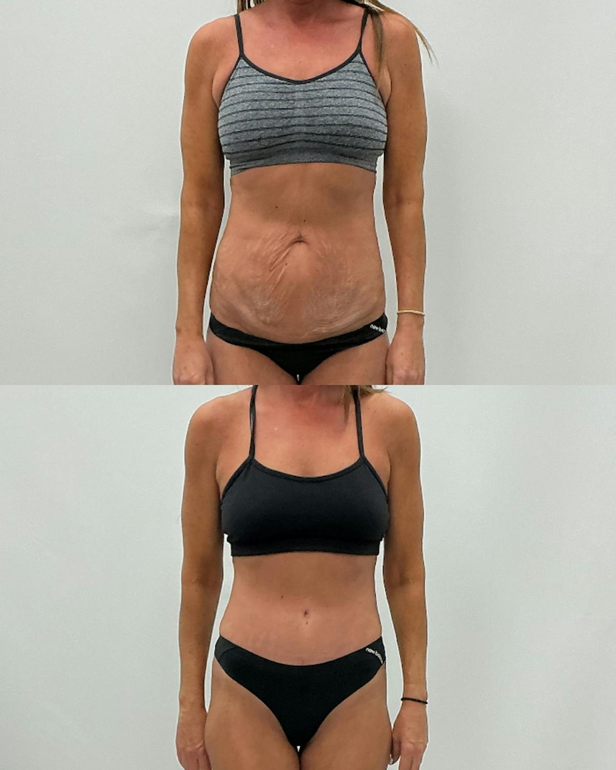 Tummy Tuck Before & After Gallery - Patient 305788 - Image 1