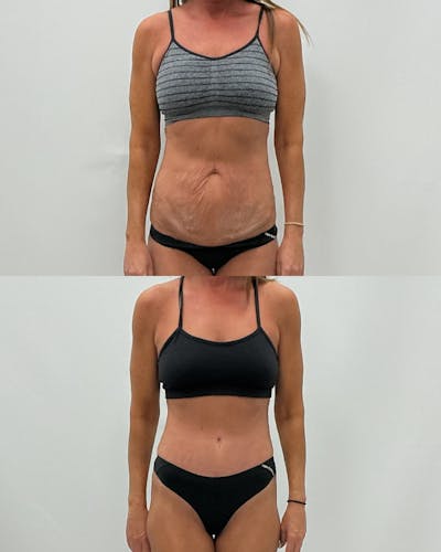 Tummy Tuck Before & After Gallery - Patient 210836 - Image 1