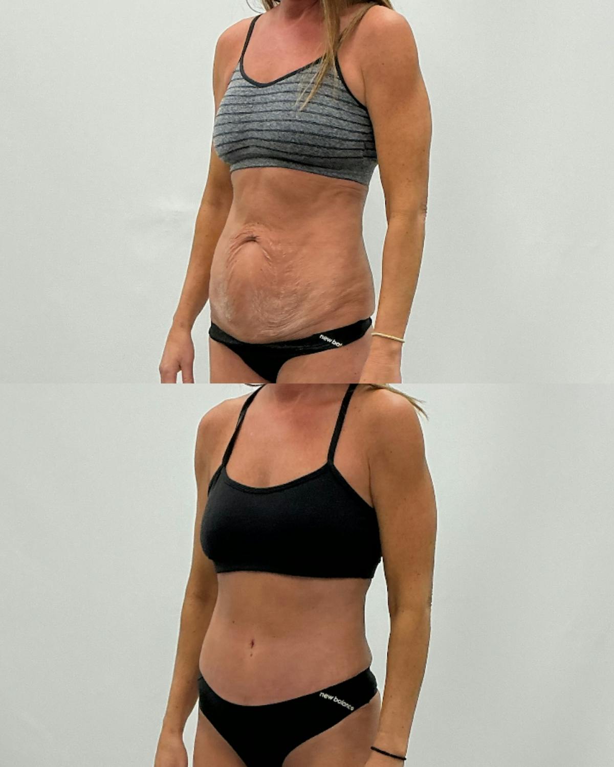 Tummy Tuck Before & After Gallery - Patient 305788 - Image 2