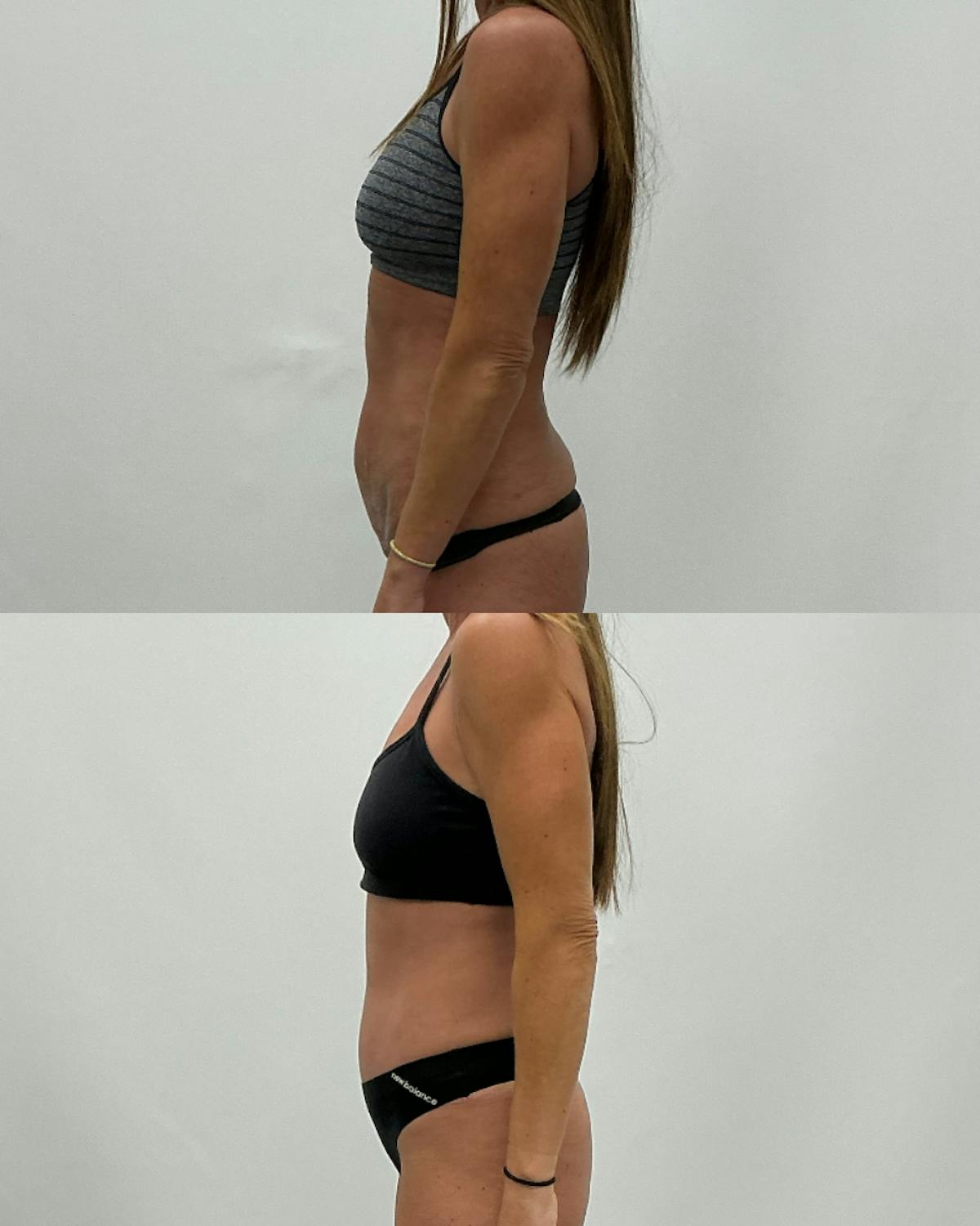 Tummy Tuck Before & After Gallery - Patient 305788 - Image 3