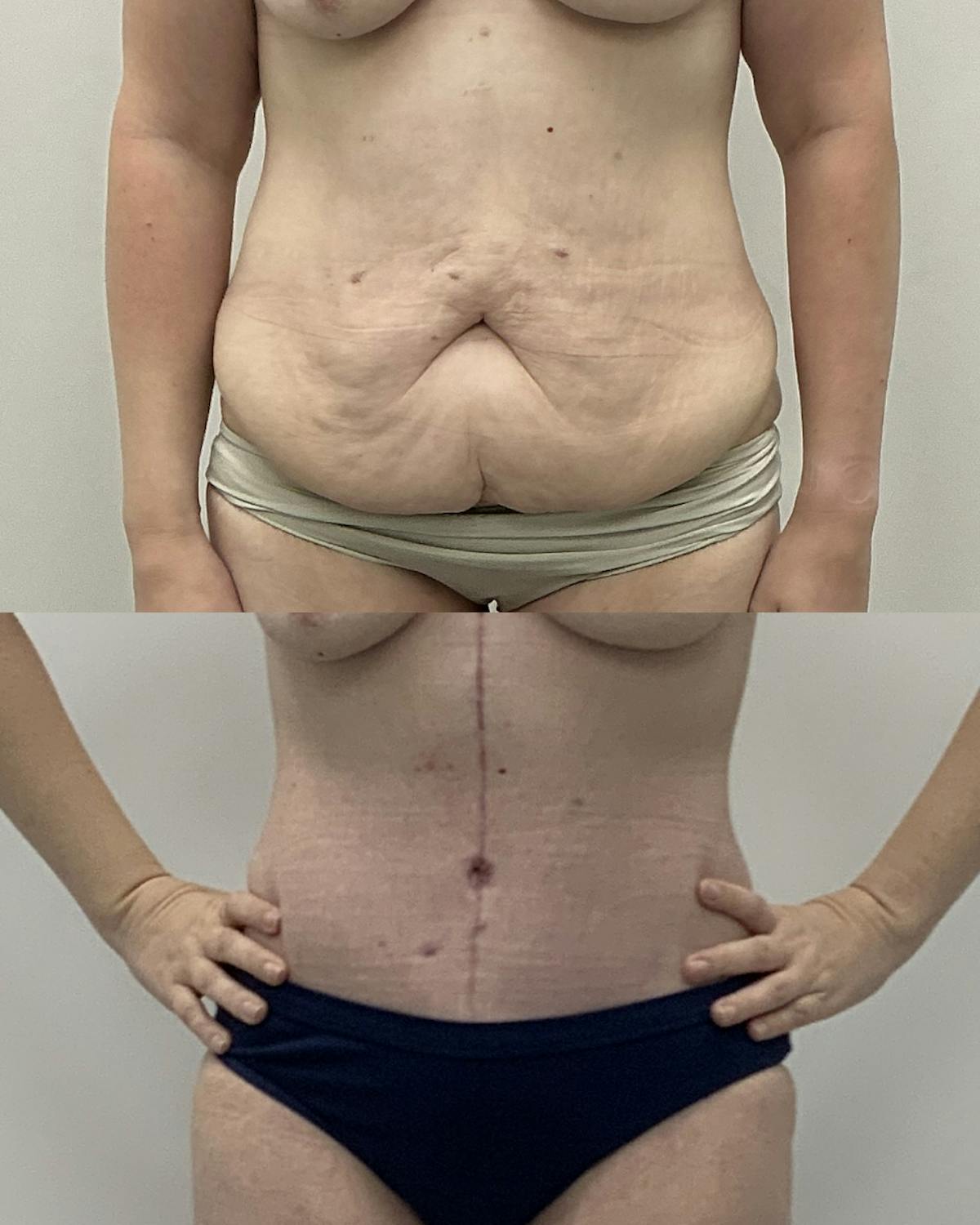 Tummy Tuck Before & After Gallery - Patient 107027 - Image 1
