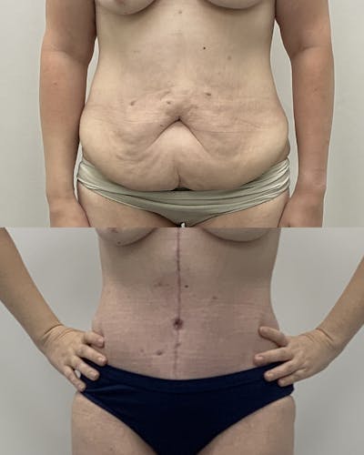 Tummy Tuck Before & After Gallery - Patient 107027 - Image 1