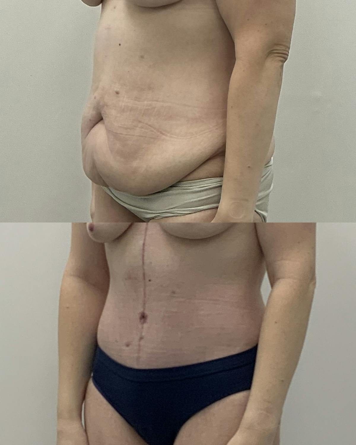 Tummy Tuck Before & After Gallery - Patient 107027 - Image 2