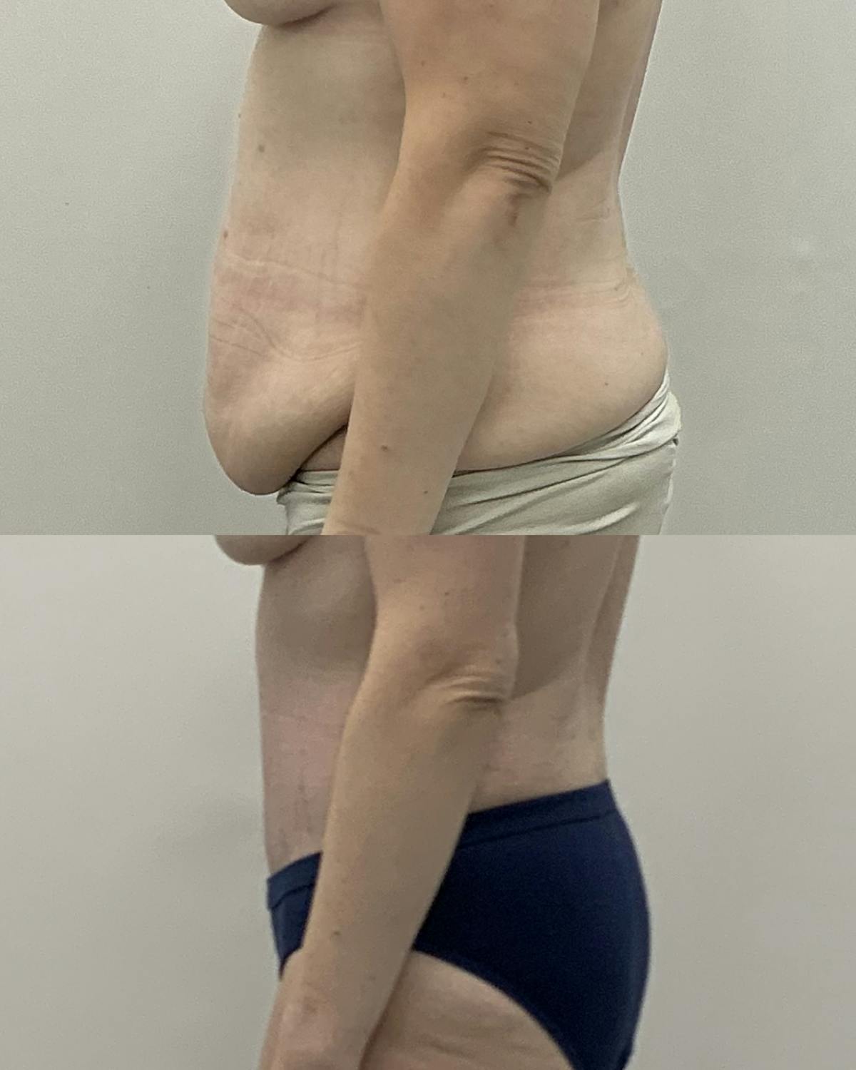 Tummy Tuck Before & After Gallery - Patient 107027 - Image 3