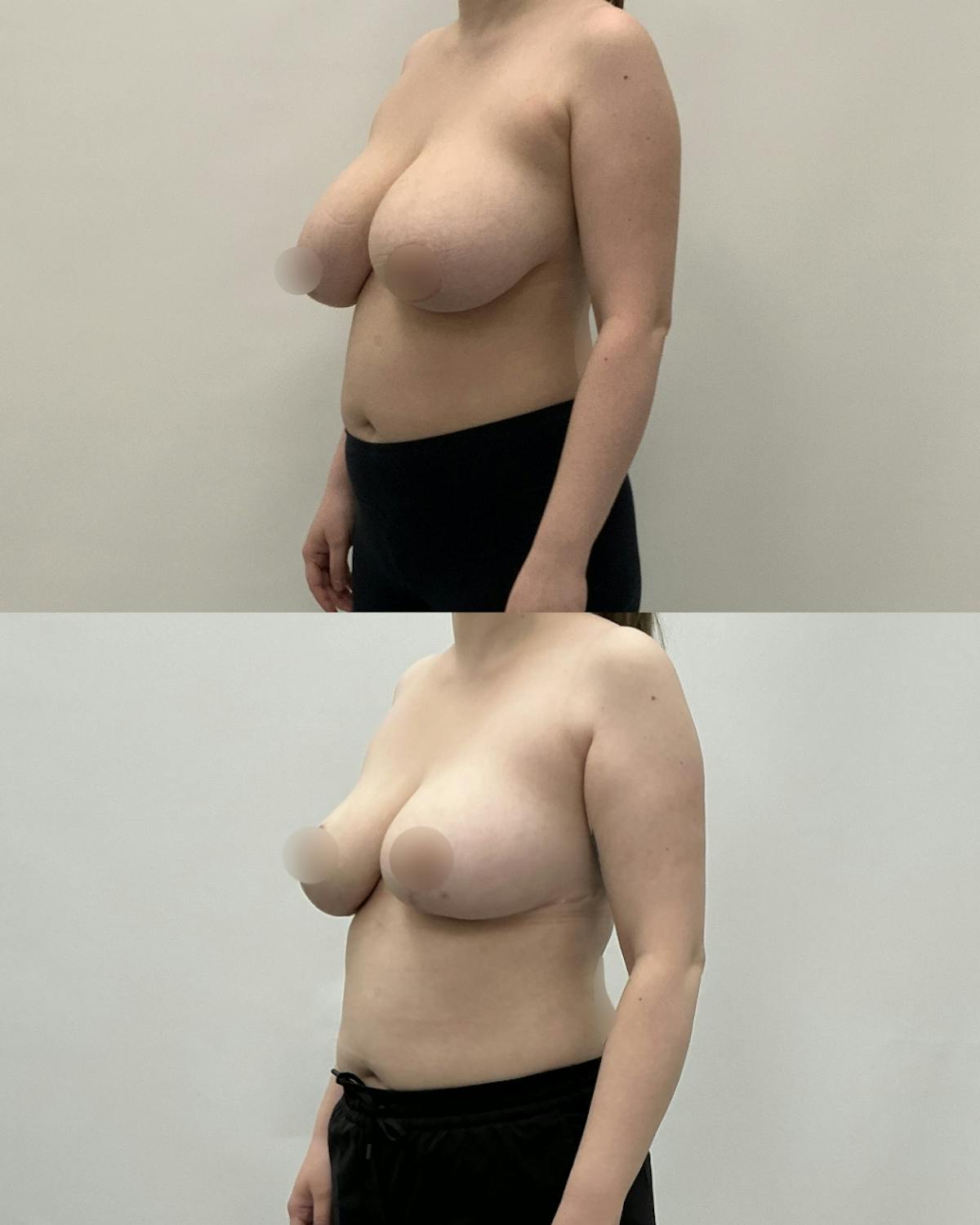 Breast Reduction Before & After Gallery - Patient 300327 - Image 1