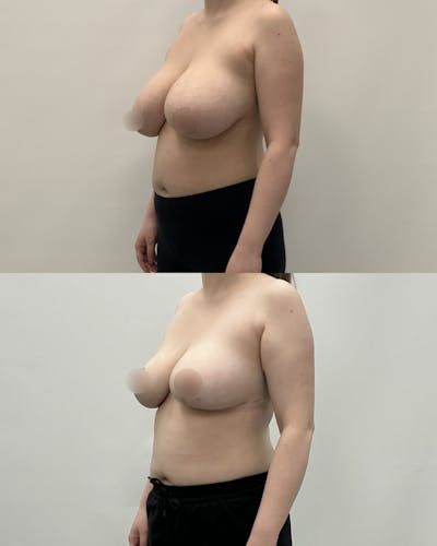 Breast Reduction Before & After Gallery - Patient 300327 - Image 1