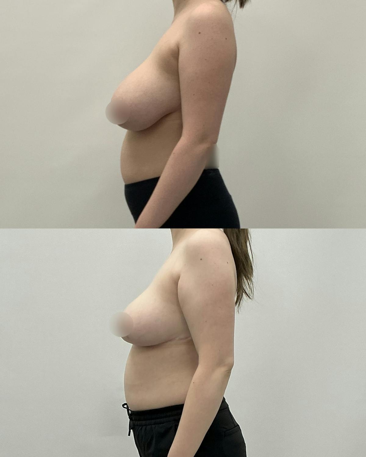 Breast Reduction Before & After Gallery - Patient 300327 - Image 2