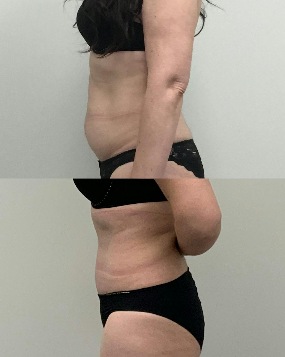 Tummy Tuck Before & After Gallery - Patient 294279 - Image 2