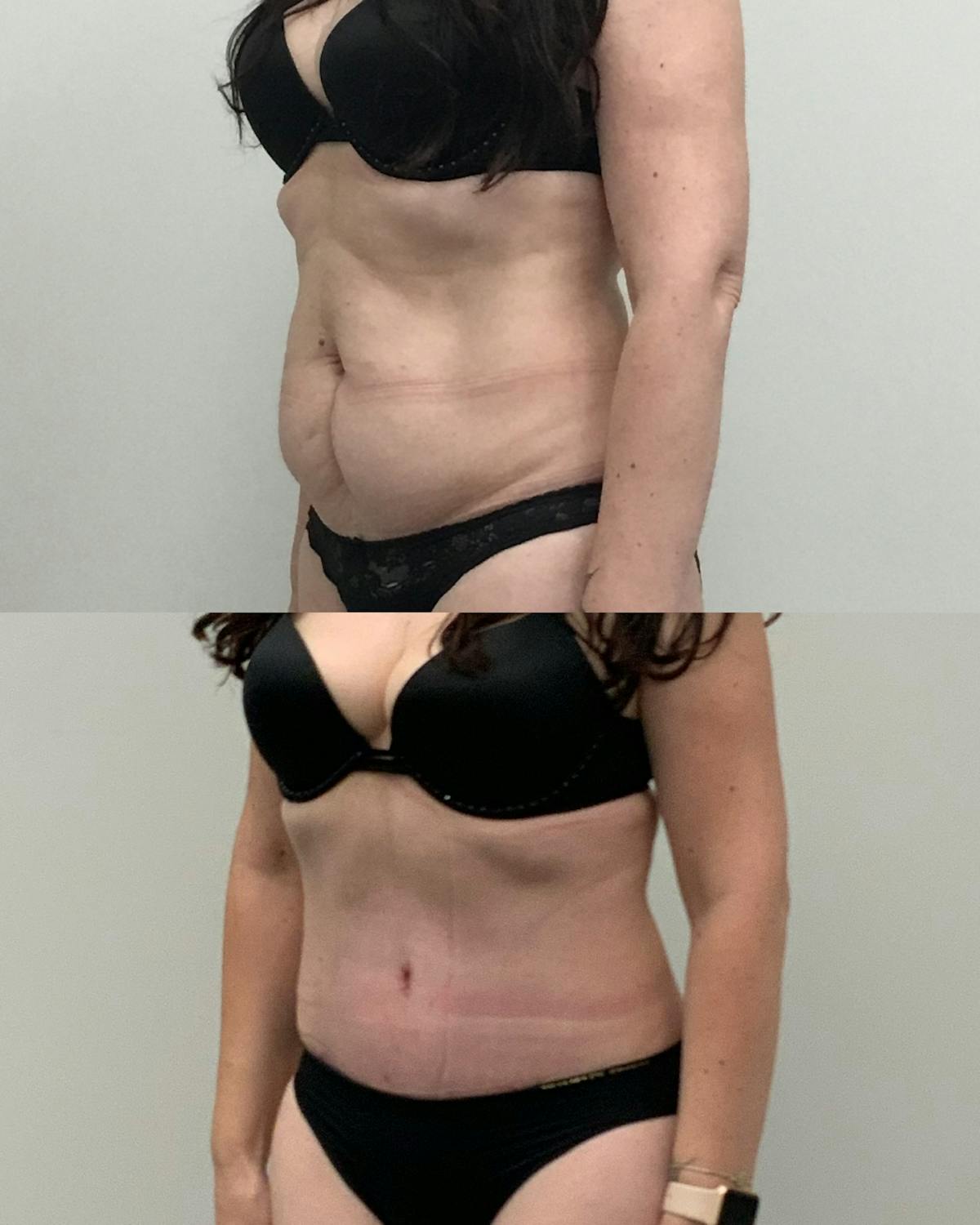 Tummy Tuck Before & After Gallery - Patient 294279 - Image 3
