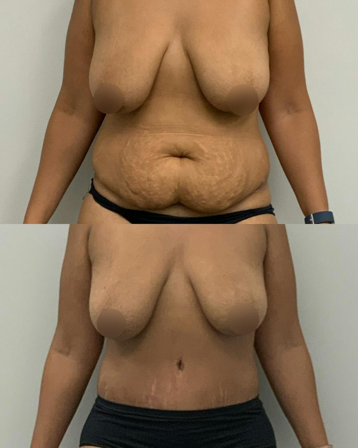 Tummy Tuck Before & After Gallery - Patient 210440 - Image 1
