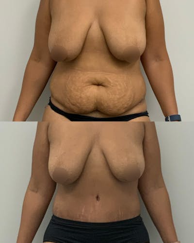 Tummy Tuck Before & After Gallery - Patient 210440 - Image 1