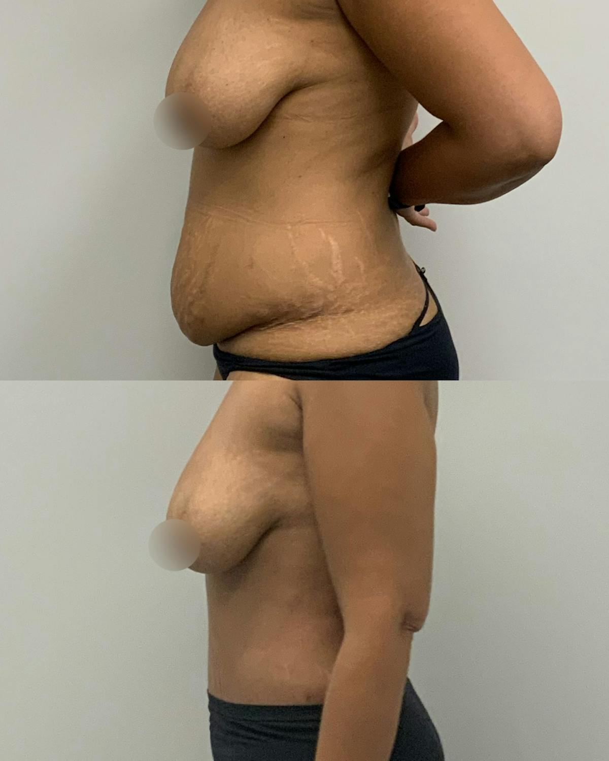 Tummy Tuck Before & After Gallery - Patient 210440 - Image 3