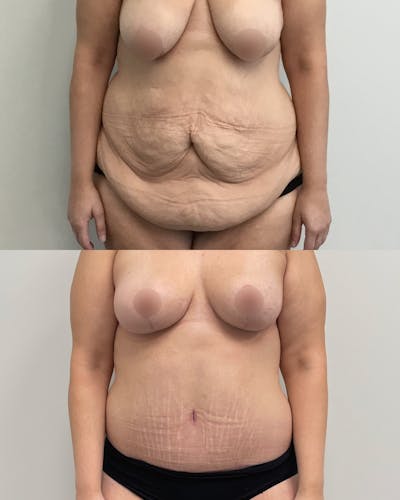 Tummy Tuck Before & After Gallery - Patient 305869 - Image 1
