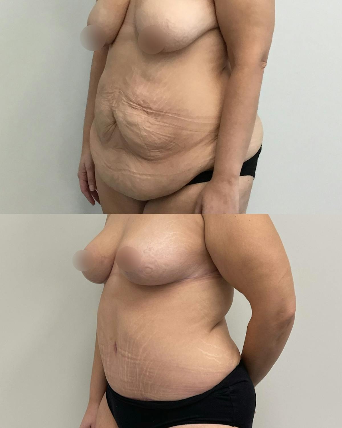 Tummy Tuck Before & After Gallery - Patient 305869 - Image 2