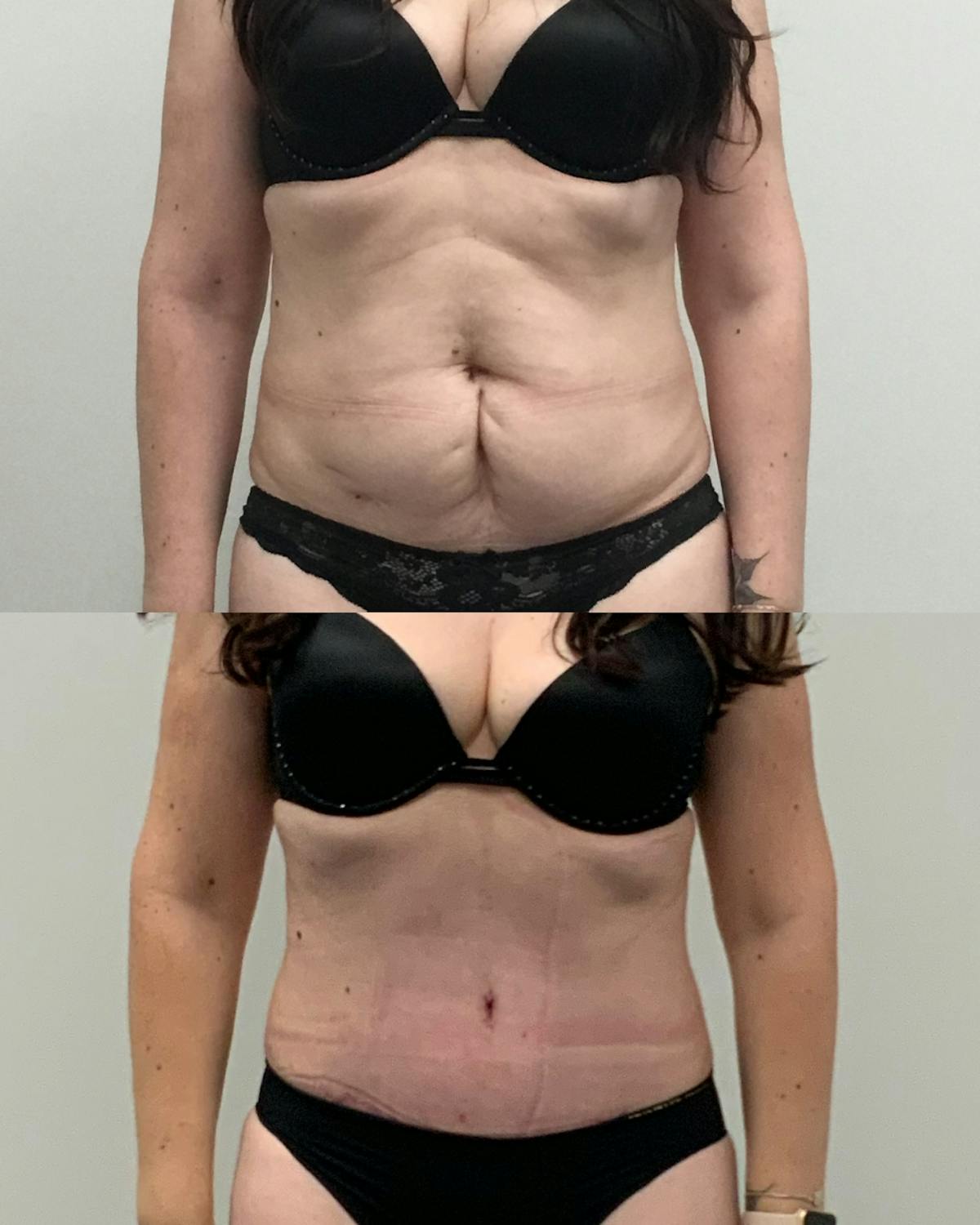 Tummy Tuck Before & After Gallery - Patient 294279 - Image 1
