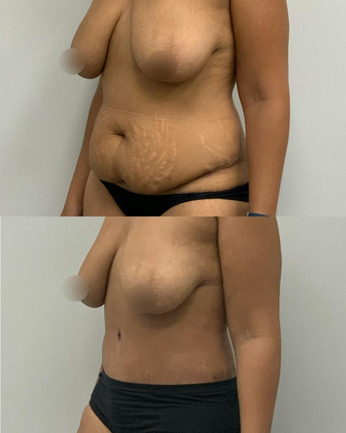 Tummy Tuck Before & After Gallery - Patient 210440 - Image 2