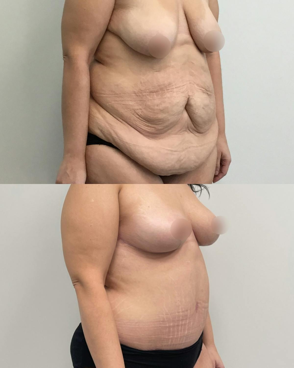Tummy Tuck Before & After Gallery - Patient 305869 - Image 3