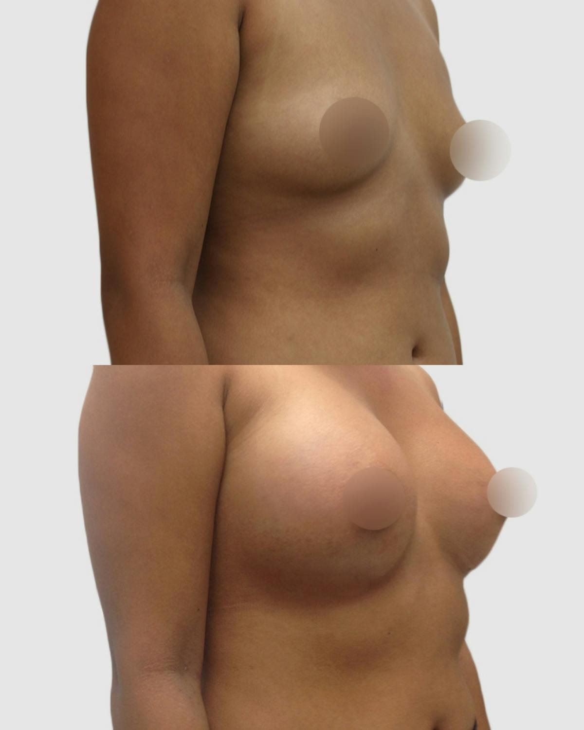 Breast Augmentation Before & After Gallery - Patient 220879 - Image 2