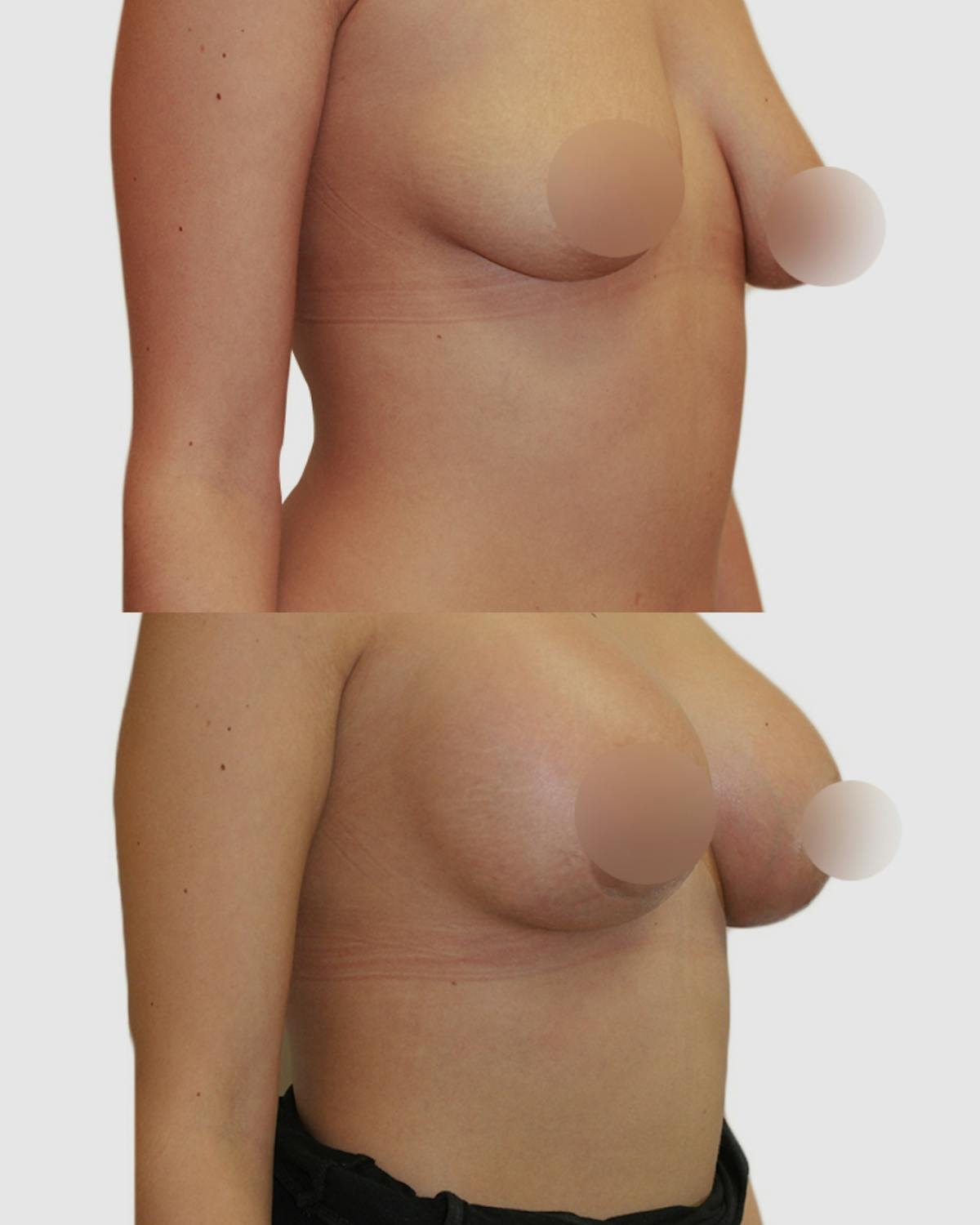 Breast Augmentation Before & After Gallery - Patient 343995 - Image 3