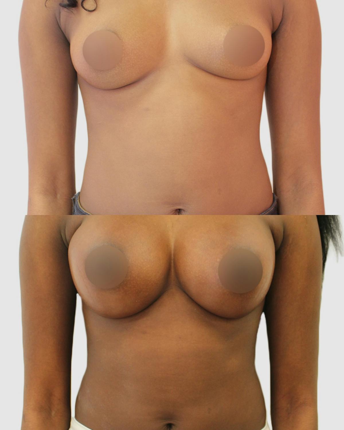 Breast Augmentation Before & After Gallery - Patient 218668 - Image 1