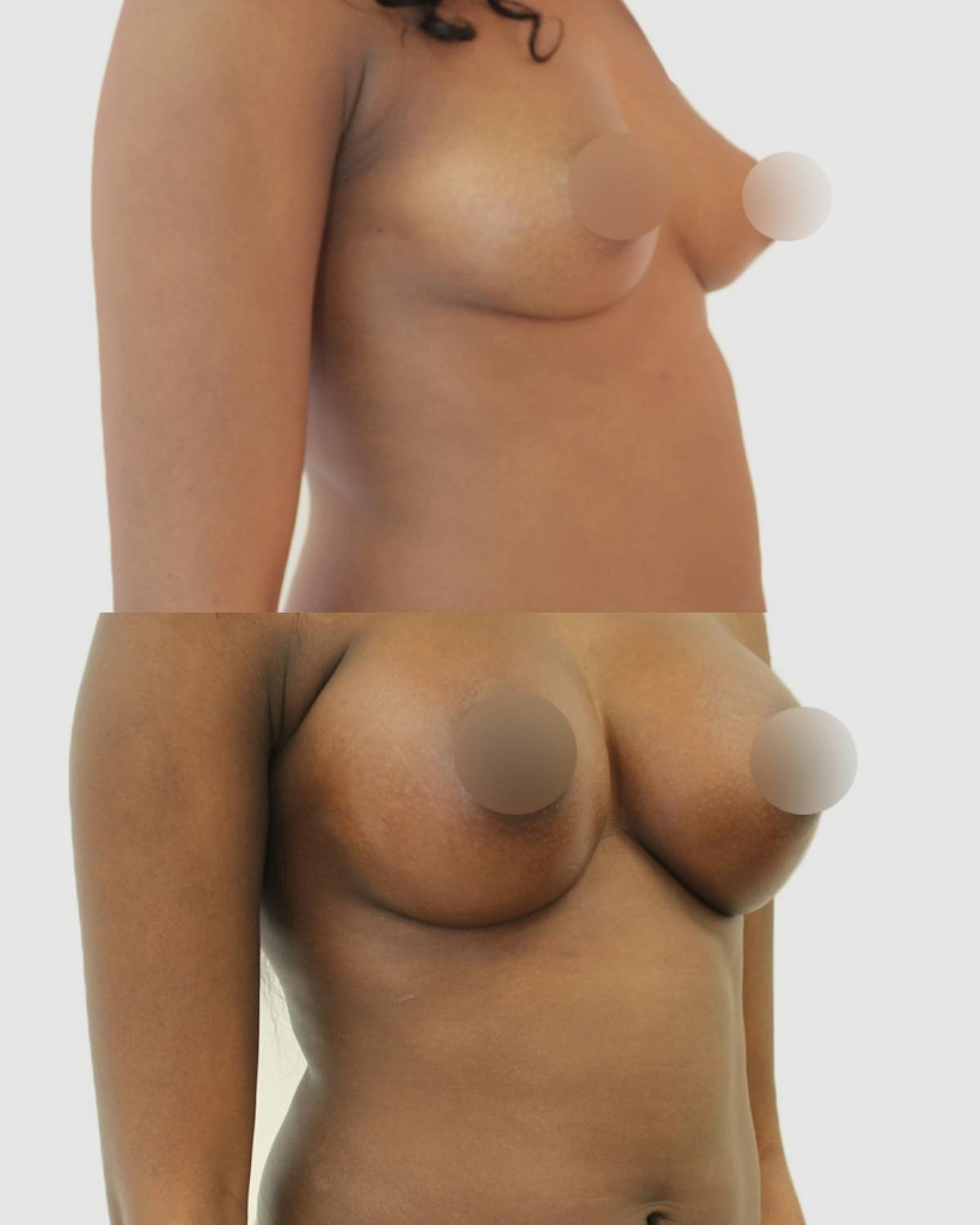 Breast Augmentation Before & After Gallery - Patient 218668 - Image 2