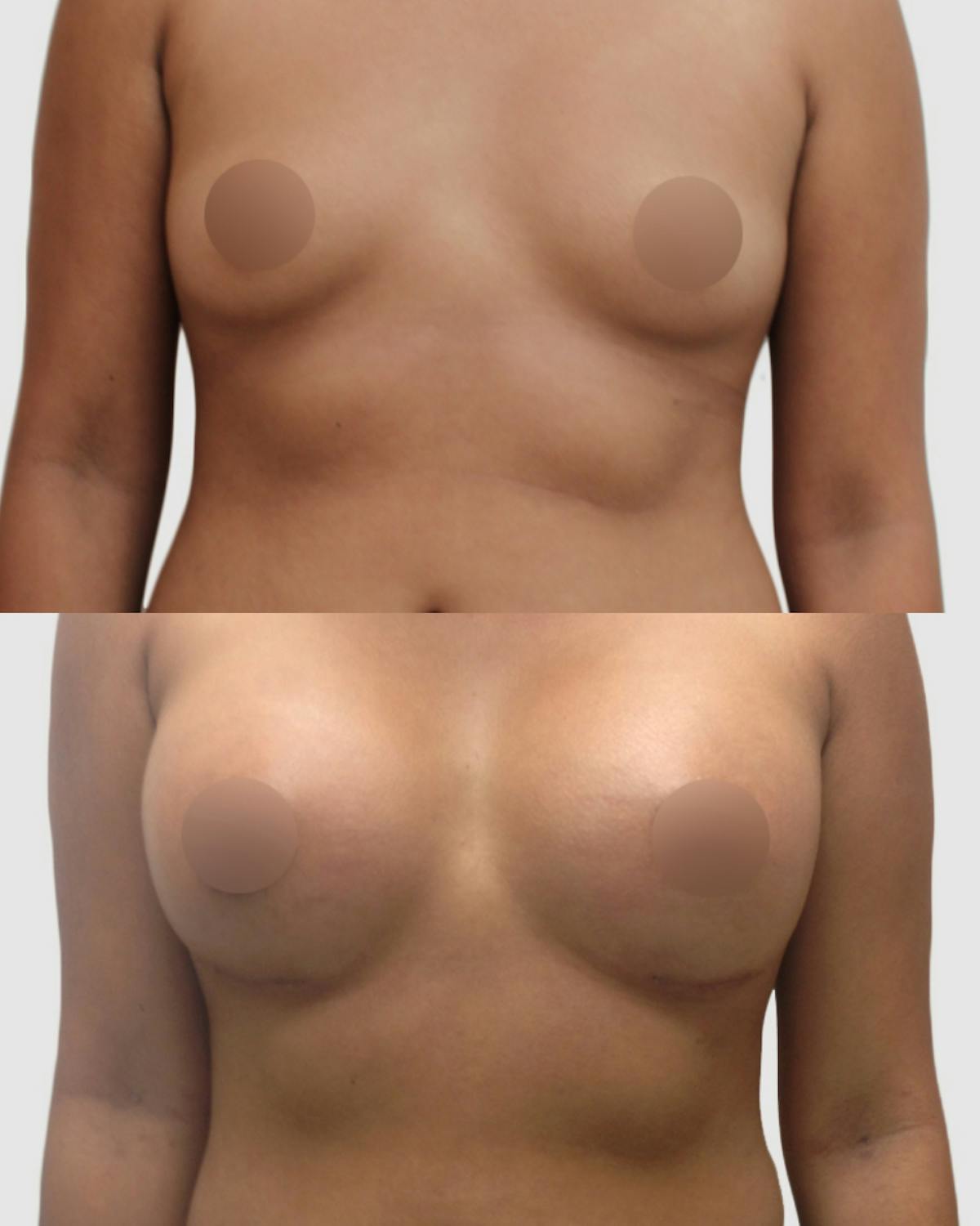 Breast Augmentation Before & After Gallery - Patient 220879 - Image 1