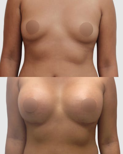 Breast Augmentation Before & After Gallery - Patient 220879 - Image 1