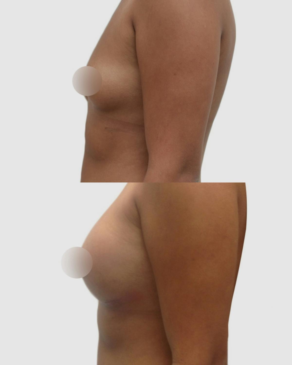 Breast Augmentation Before & After Gallery - Patient 220879 - Image 3