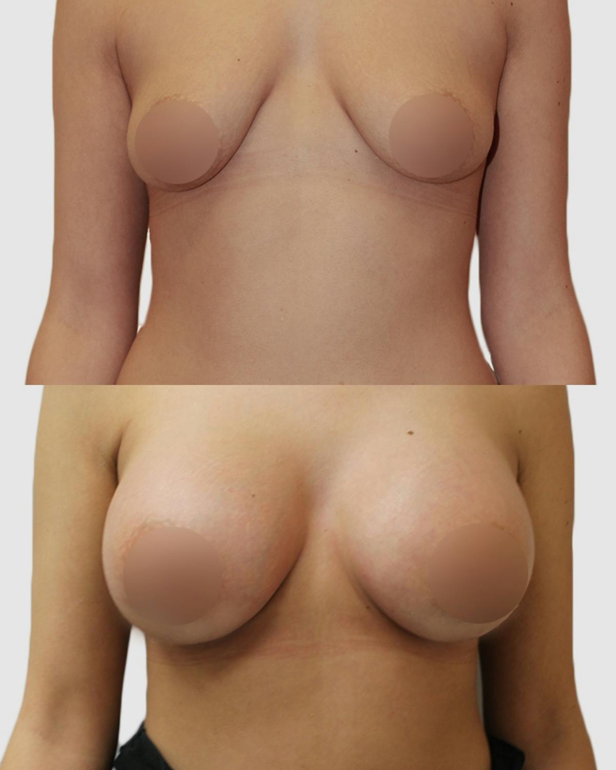 Breast Augmentation Before & After Gallery - Patient 343995 - Image 1