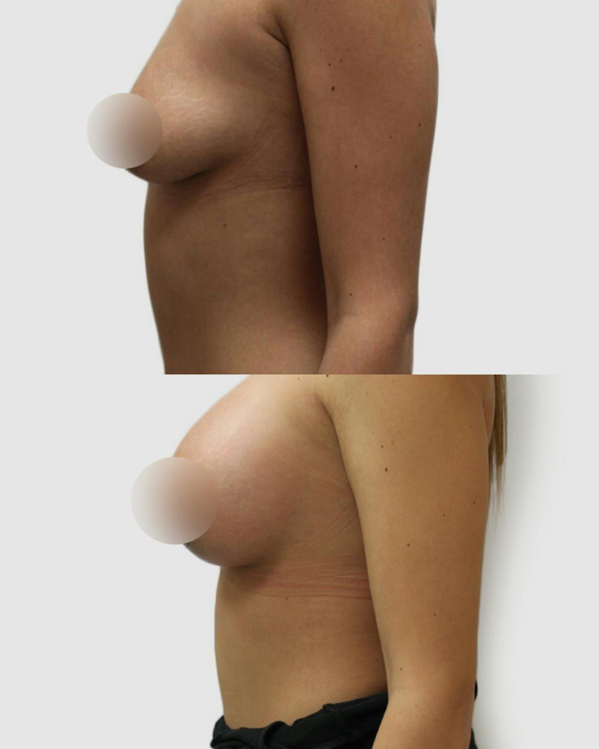 Breast Augmentation Before & After Gallery - Patient 343995 - Image 2