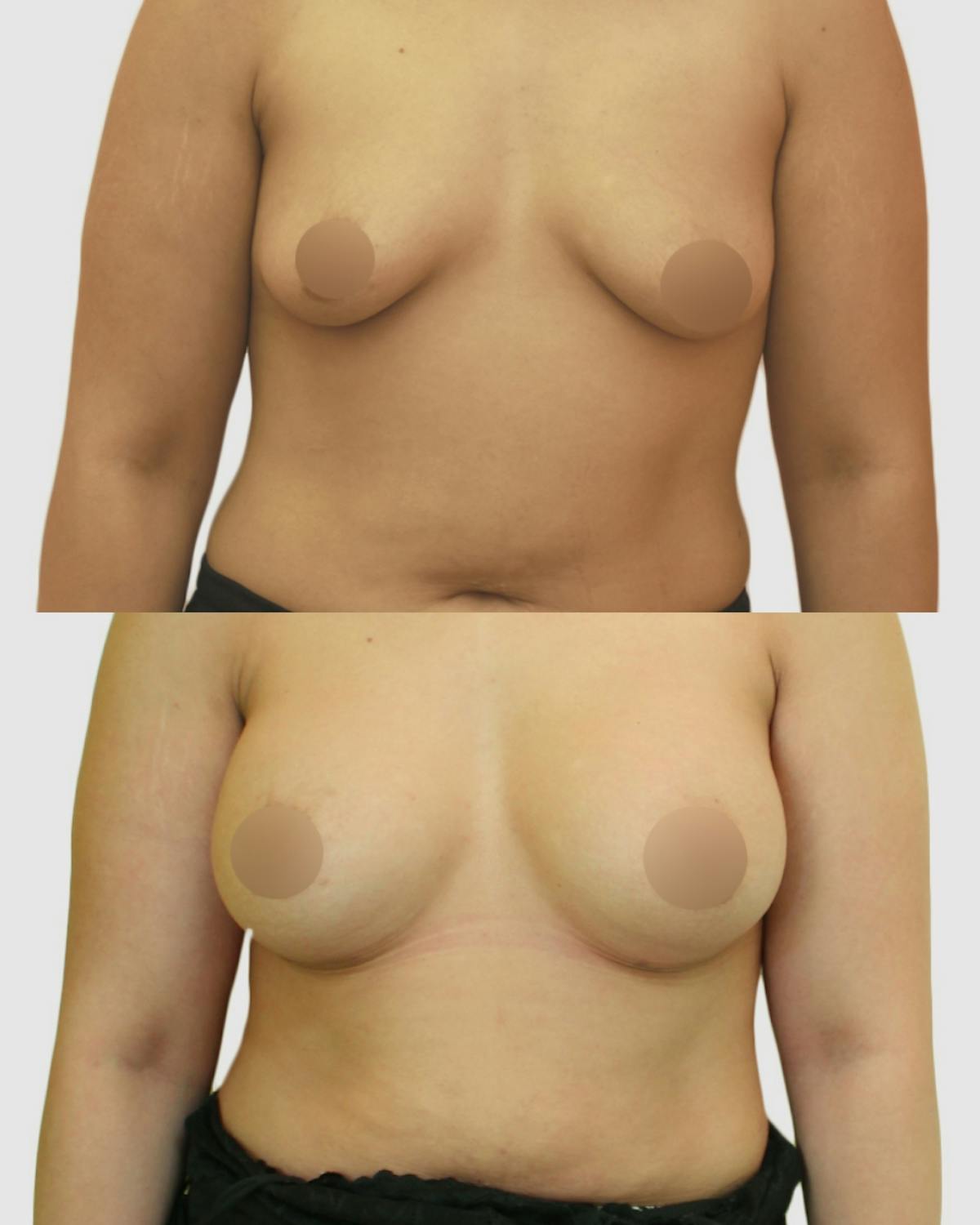 Breast Augmentation Before & After Gallery - Patient 229109 - Image 1