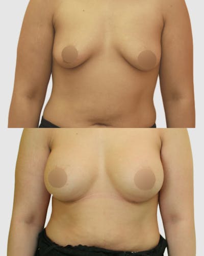 Breast Augmentation Before & After Gallery - Patient 229109 - Image 1