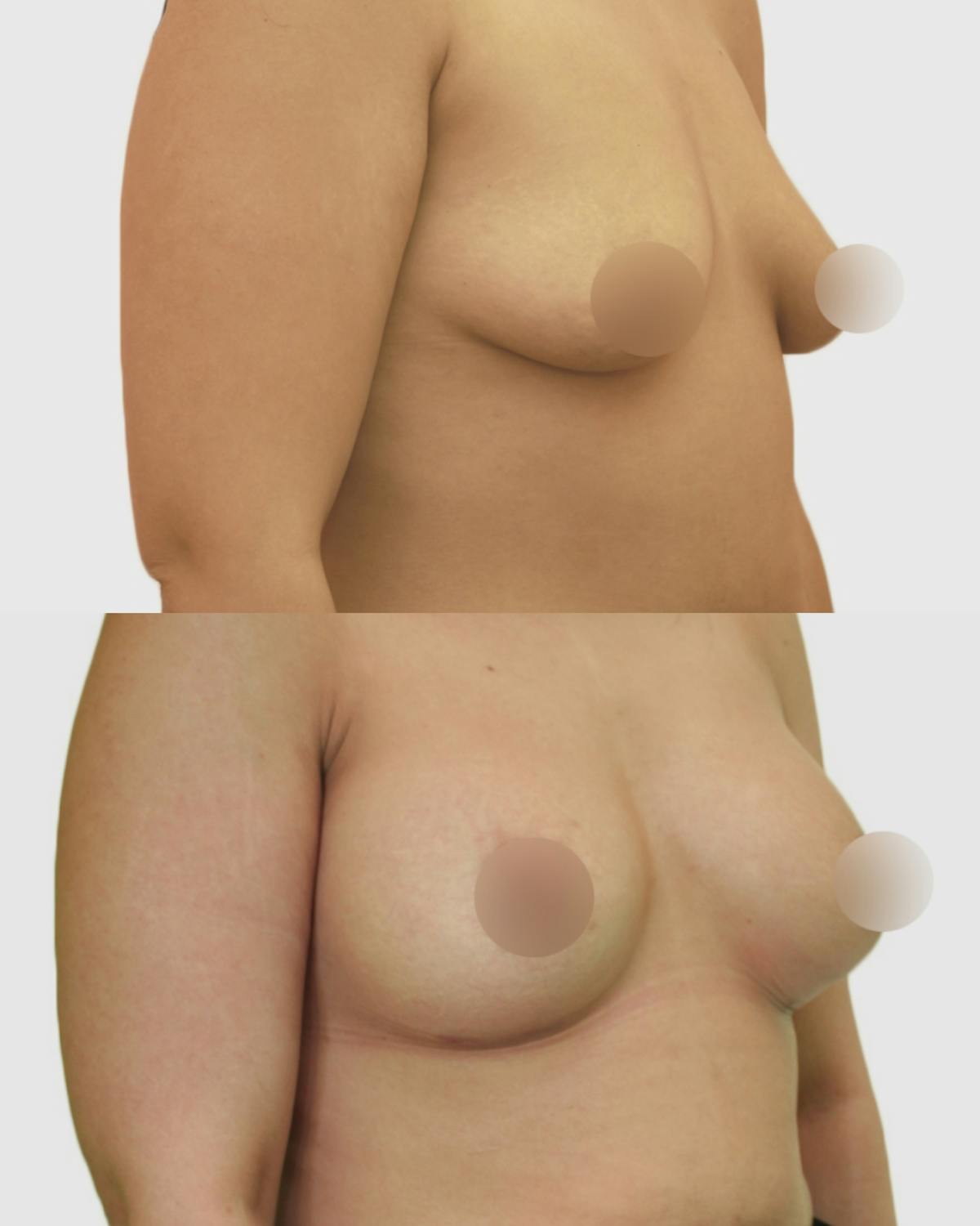 Breast Augmentation Before & After Gallery - Patient 229109 - Image 2