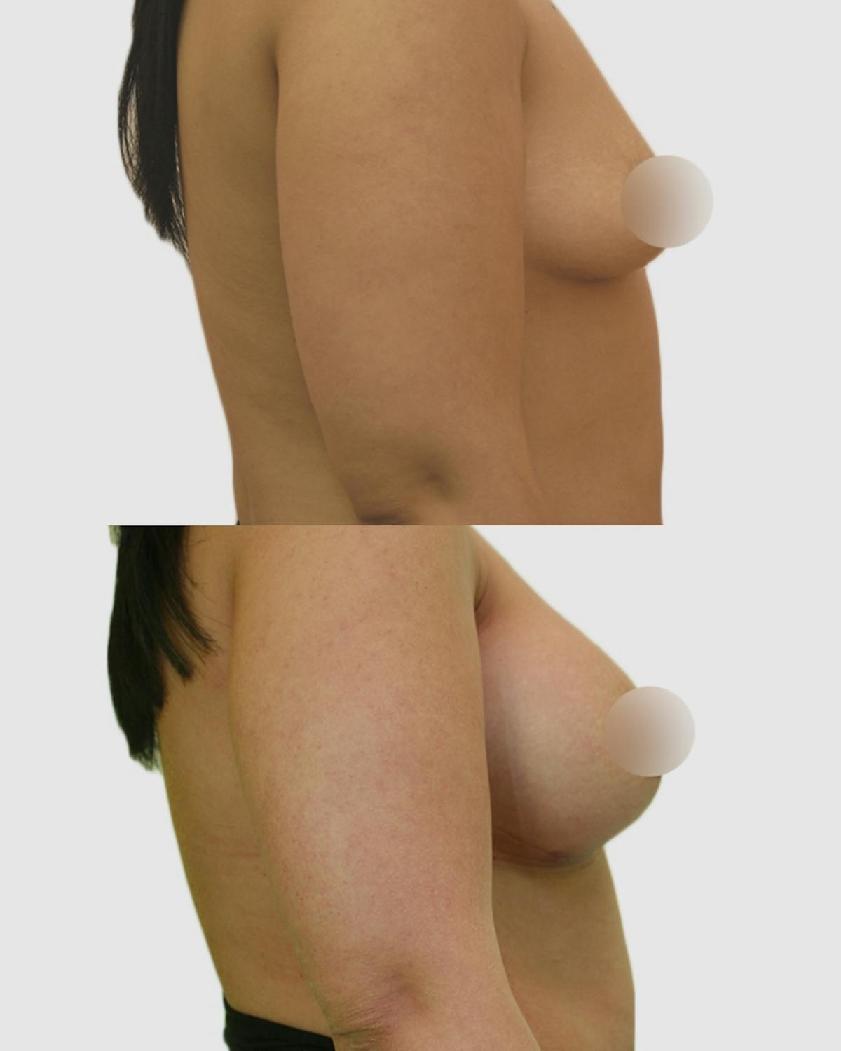 Breast Augmentation Before & After Gallery - Patient 229109 - Image 3